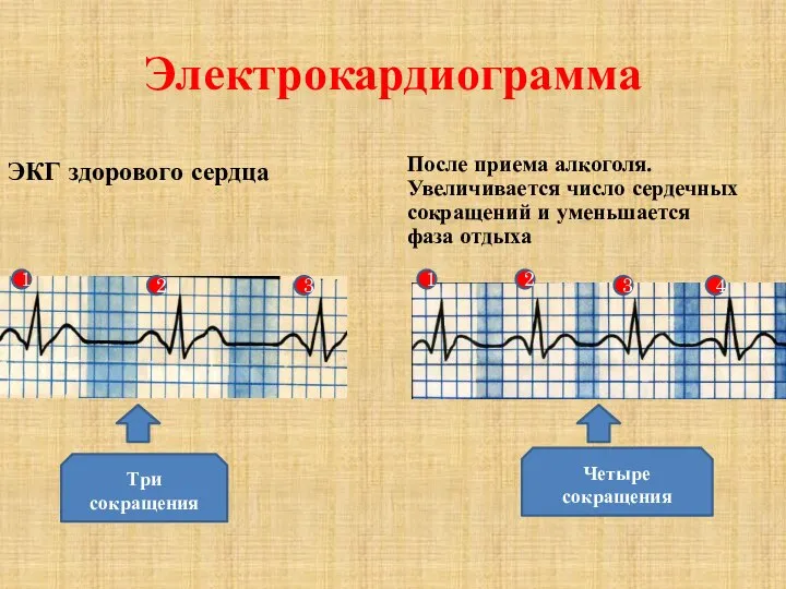Электрокардиограмма ЭКГ здорового сердца После приема алкоголя. Увеличивается число сердечных сокращений и