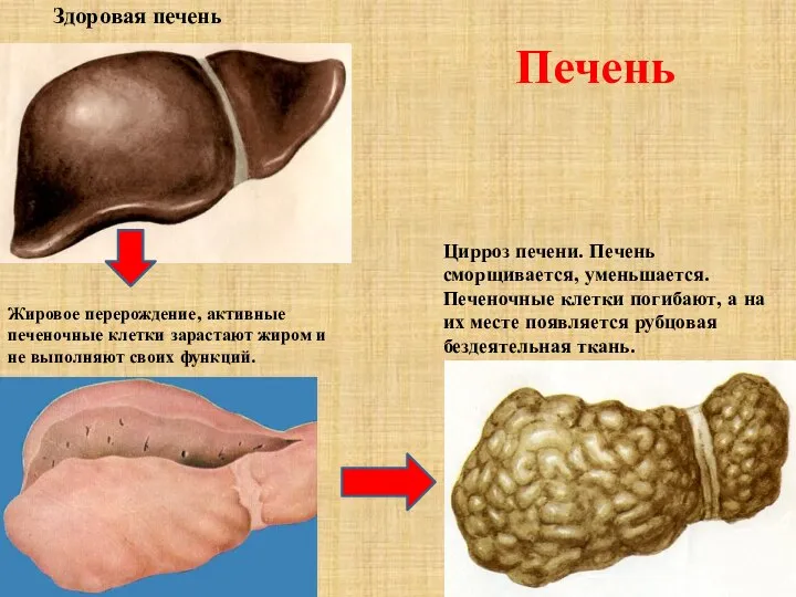 Печень Здоровая печень Цирроз печени. Печень сморщивается, уменьшается. Печеночные клетки погибают, а