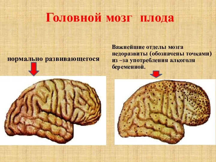 Головной мозг плода нормально развивающегося Важнейшие отделы мозга недоразвиты (обозначены точками) из –за употребления алкоголя беременной.