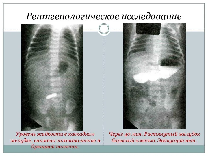 Рентгенологическое исследование Через 40 мин. Растянутый желудок бариевой взвесью. Эвакуации нет. Уровень