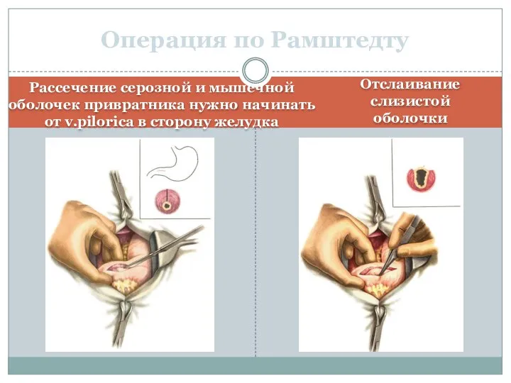 Рассечение серозной и мышечной оболочек привратника нужно начинать от v.pilorica в сторону