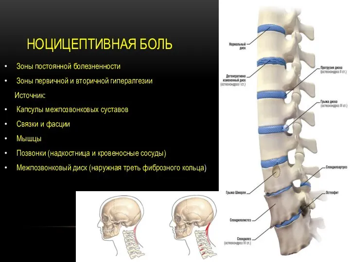 Зоны постоянной болезненности Зоны первичной и вторичной гипералгезии Источник: Капсулы межпозвонковых суставов