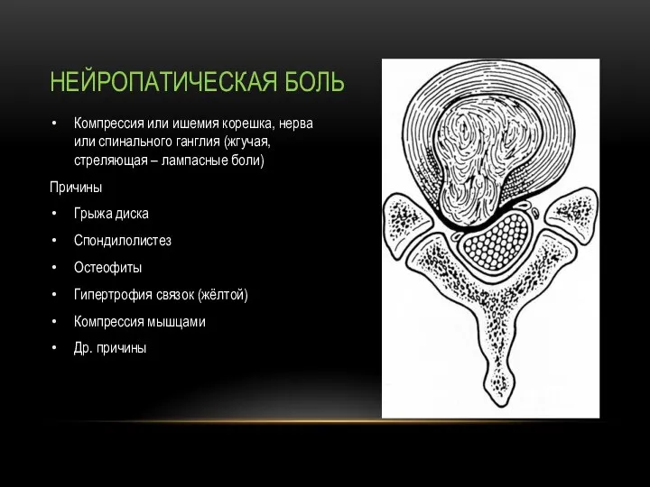 Компрессия или ишемия корешка, нерва или спинального ганглия (жгучая, стреляющая – лампасные