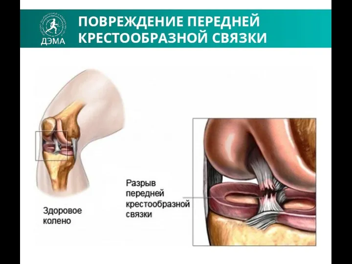 ПОВРЕЖДЕНИЕ ПЕРЕДНЕЙ КРЕСТООБРАЗНОЙ СВЯЗКИ