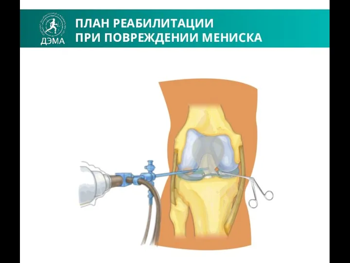 ПЛАН РЕАБИЛИТАЦИИ ПРИ ПОВРЕЖДЕНИИ МЕНИСКА