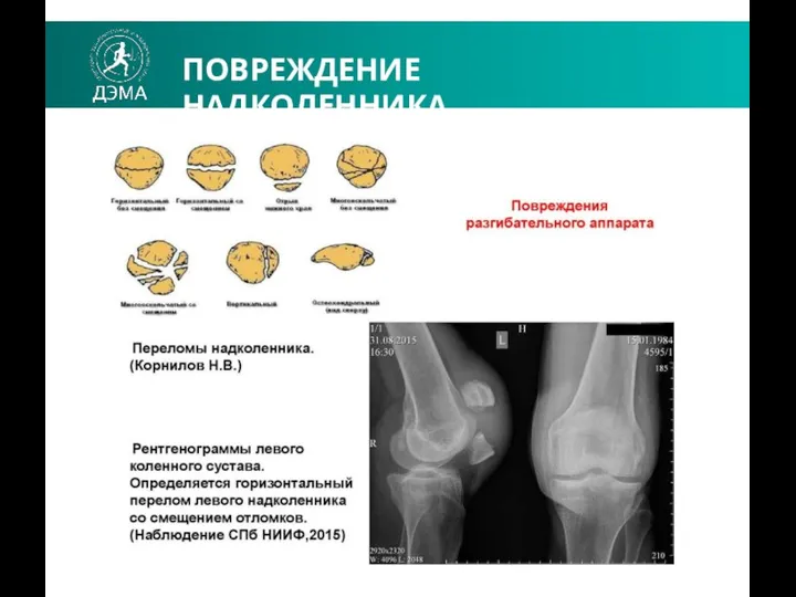 ПОВРЕЖДЕНИЕ НАДКОЛЕННИКА