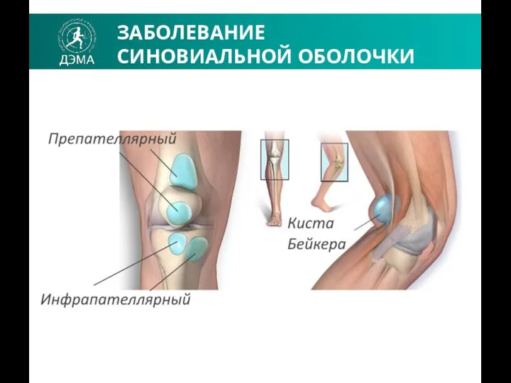 ЗАБОЛЕВАНИЕ СИНОВИАЛЬНОЙ ОБОЛОЧКИ