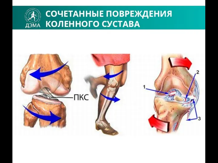 СОЧЕТАННЫЕ ПОВРЕЖДЕНИЯ КОЛЕННОГО СУСТАВА