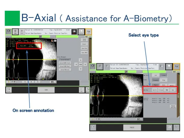 Select eye type On screen annotation