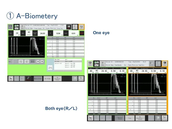 ① A-Biometery One eye Both eye（R／L）