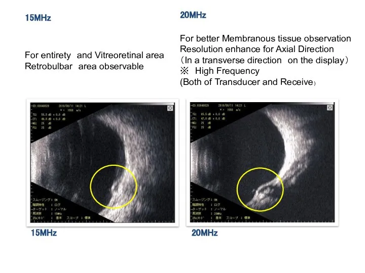 15MHz 20MHz For entirety and Vitreoretinal area Retrobulbar area observable For better