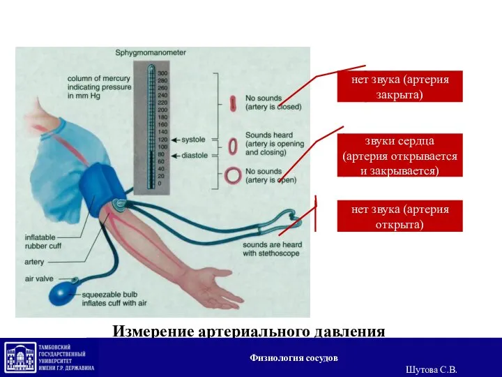 Измерение артериального давления нет звука (артерия закрыта) звуки сердца (артерия открывается и