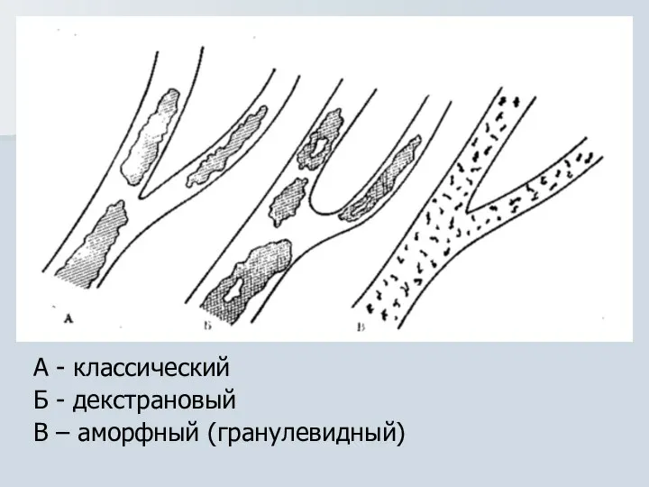 А - классический Б - декстрановый В – аморфный (гранулевидный)