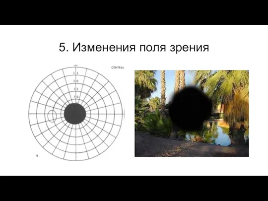 5. Изменения поля зрения