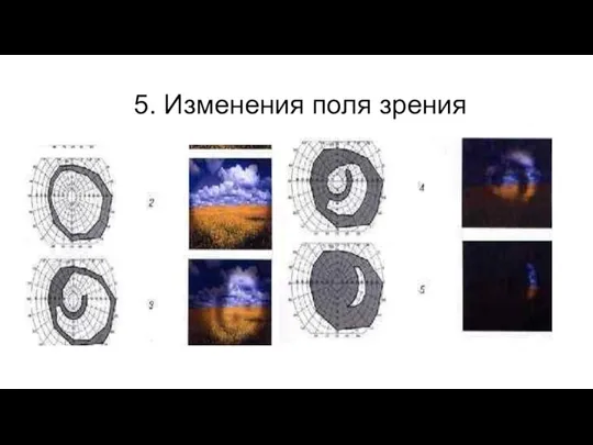 5. Изменения поля зрения