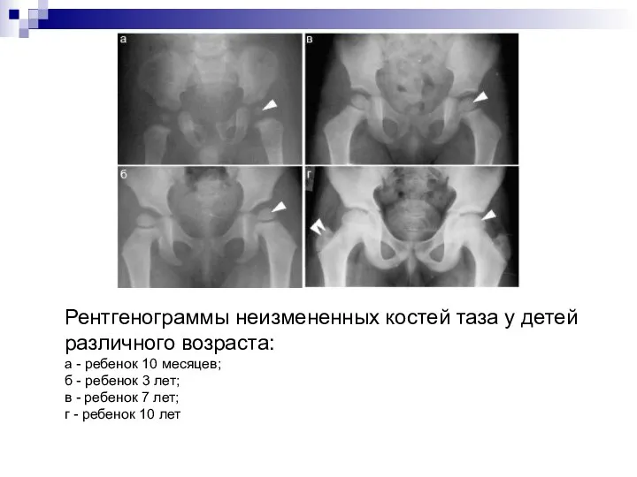 Рентгенограммы неизмененных костей таза у детей различного возраста: а - ребенок 10