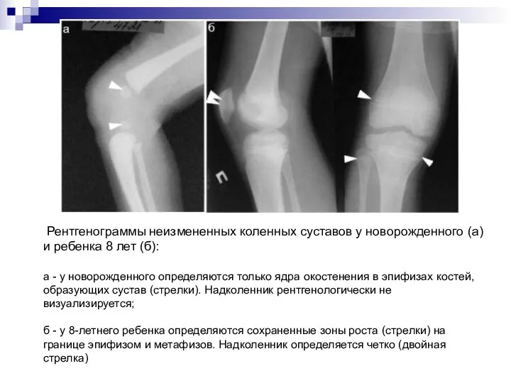 Рентгенограммы неизмененных коленных суставов у новорожденного (а) и ребенка 8 лет (б):