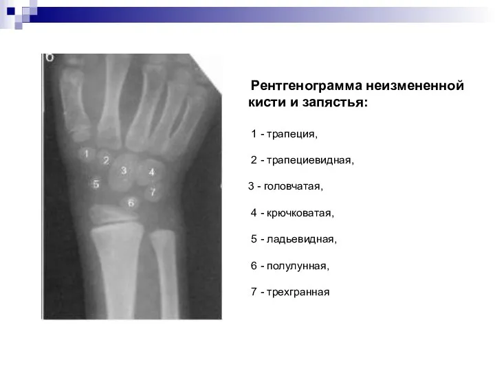 Рентгенограмма неизмененной кисти и запястья: 1 - трапеция, 2 - трапециевидная, 3