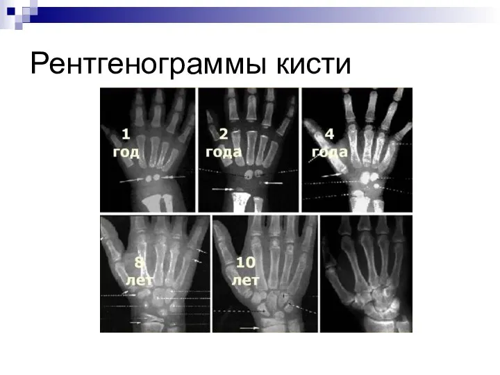 Рентгенограммы кисти