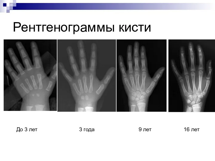 Рентгенограммы кисти До 3 лет 3 года 9 лет 16 лет