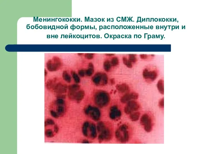 Менингококки. Мазок из СМЖ. Диплококки, бобовидной формы, расположенные внутри и вне лейкоцитов. Окраска по Граму.