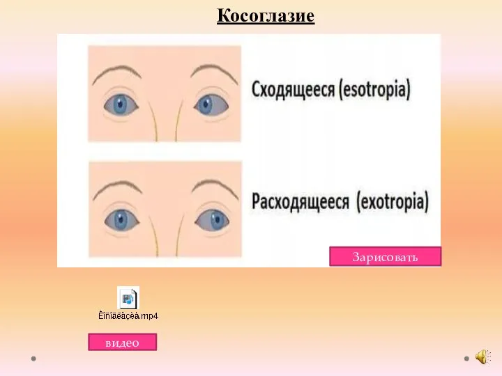 Зарисовать Косоглазие видео