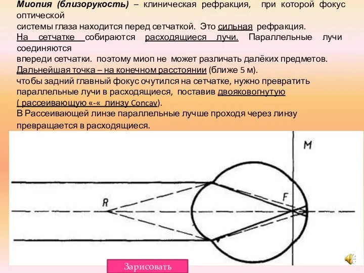 Миопия (близорукость) – клиническая рефракция, при которой фокус оптической системы глаза находится