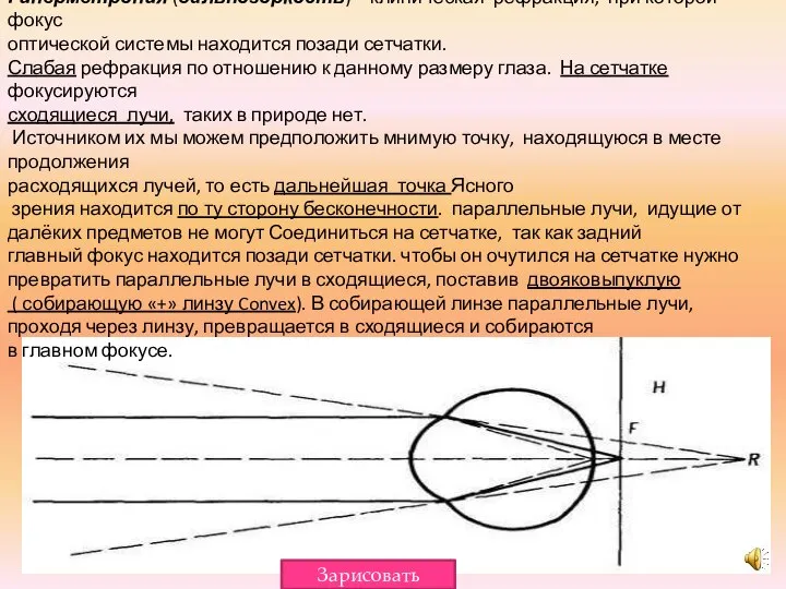 Гиперметропия (дальнозоркость) – клиническая рефракция, при которой фокус оптической системы находится позади