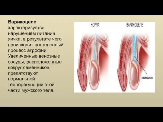 Варикоцеле характеризуется нарушением питания яичка, в результате чего происходит постепенный процесс атрофии.