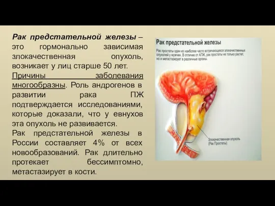 Рак предстательной железы – это гормонально зависимая злокачественная опухоль, возникает у лиц