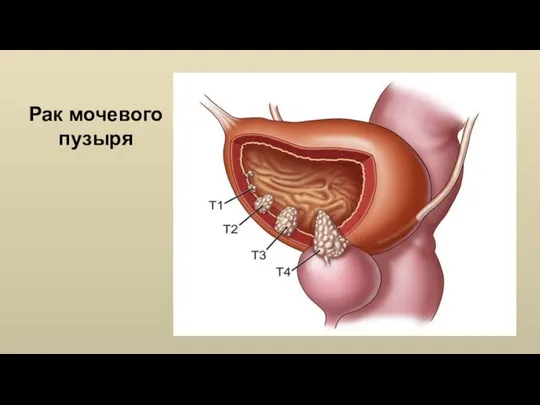 Рак мочевого пузыря