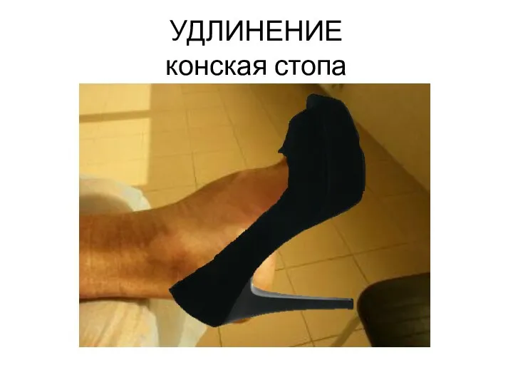 УДЛИНЕНИЕ конская стопа