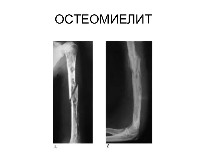 ОСТЕОМИЕЛИТ