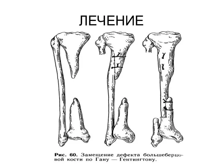 ЛЕЧЕНИЕ