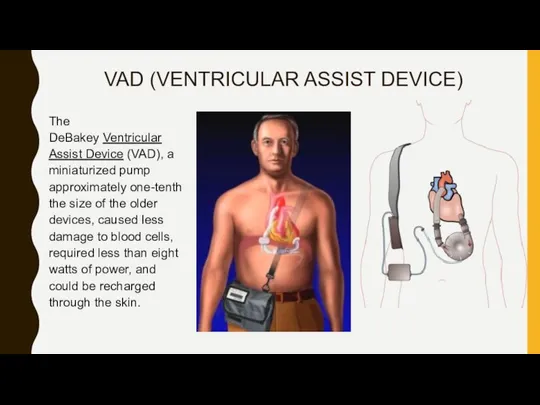 VAD (VENTRICULAR ASSIST DEVICE) The DeBakey Ventricular Assist Device (VAD), a miniaturized