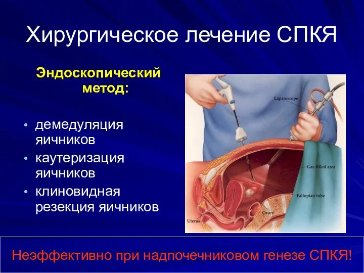 Хирургическое лечение СПКЯ Эндоскопический метод: демедуляция яичников каутеризация яичников клиновидная резекция яичников