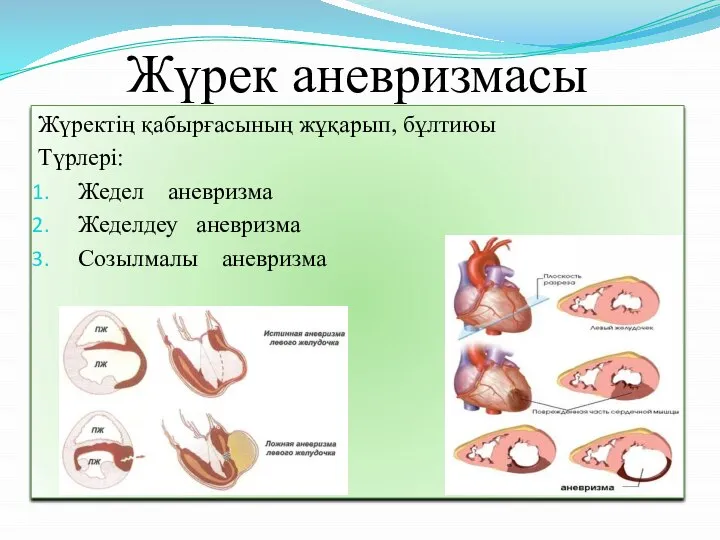 Жүрек аневризмасы Жүректің қабырғасының жұқарып, бұлтиюы Түрлері: Жедел аневризма Жеделдеу аневризма Созылмалы аневризма