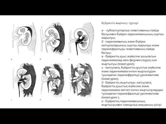 Бүйректің жыртылу түрлері а - субкапсулярлық гематоманың пайда болуымен бүйрек паренхимасының сыртқы