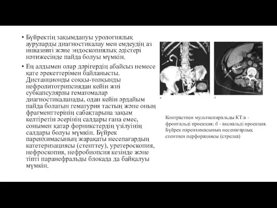 Бүйректің зақымдануы урологиялық ауруларды диагностикалау мен емдеудің аз инвазивті және эндоскопиялық әдістері