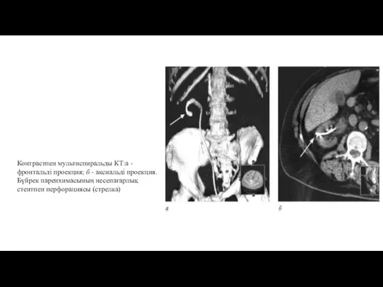 Контрастпен мультиспиральды КТ:а - фронтальді проекция; б - аксиальді проекция. Бүйрек паренхимасының несепағарлық стентпен перфорациясы (стрелка)