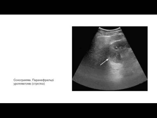 Сонограмма. Паранефральді урогематома (стрелка)