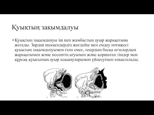 Қуықтың зақымдалуы Қуықтың зақымдануы іш пен жамбастың ауыр жарақатына жатады. Зардап шеккендердің