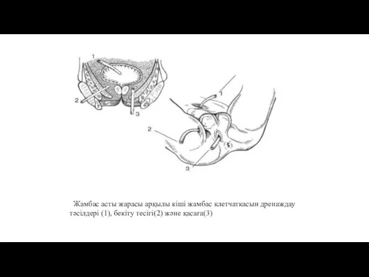 Жамбас асты жарасы арқылы кіші жамбас клетчаткасын дренаждау тәсілдері (1), бекіту тесігі(2) және қасаға(3)
