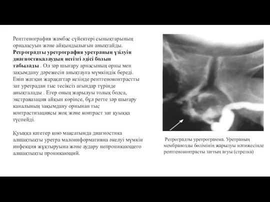 Ретроградты уретрограмма. Уретраның мембранозды бөлімінің жарылуы нәтижесінде рентгеноконтрасты заттың ағуы (стрелка) Рентгенография