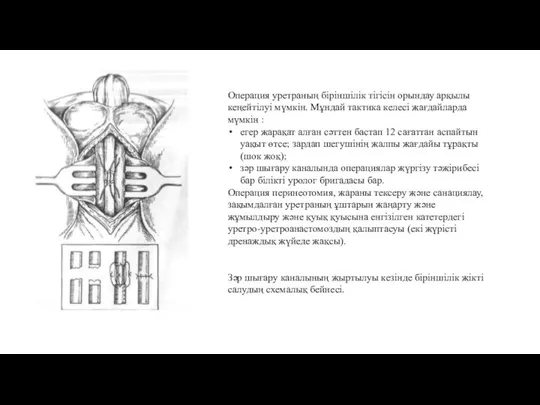 Зәр шығару каналының жыртылуы кезінде біріншілік жікті салудың схемалық бейнесі. Операция уретраның