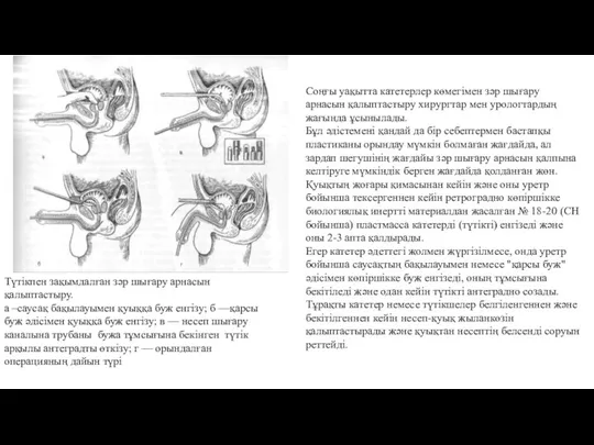 Түтікпен зақымдалған зәр шығару арнасын қалыптастыру. а –саусақ бақылауымен қуыққа буж енгізу;