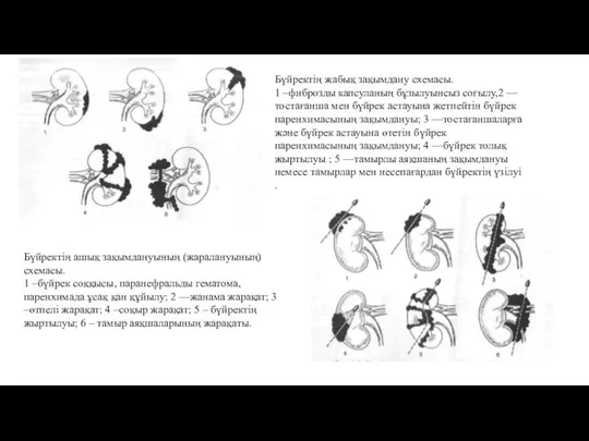 Бүйректің жабық зақымдану схемасы. 1 –фиброзды капсуланың бұзылуынсыз соғылу,2 —тостағанша мен бүйрек