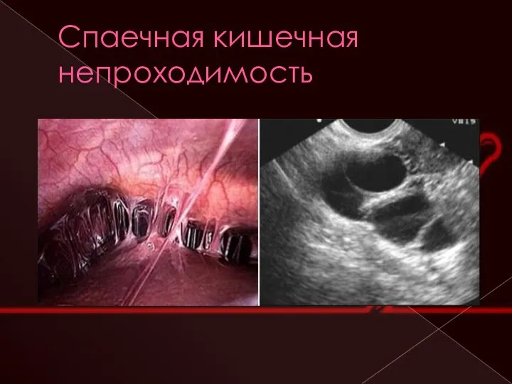 Спаечная кишечная непроходимость