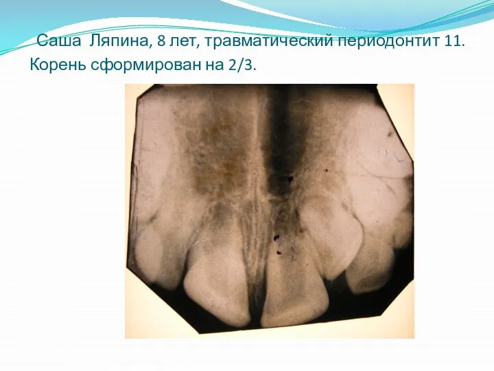 Саша Ляпина, 8 лет, травматический периодонтит 11. Корень сформирован на 2/3.