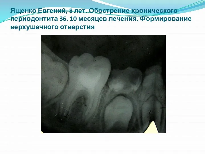 Ященко Евгений, 8 лет. Обострение хронического периодонтита 36. 10 месяцев лечения. Формирование верхушечного отверстия